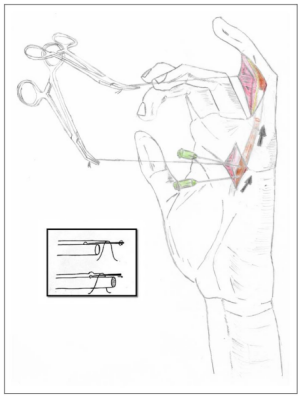 手部II区屈肌腱断裂回缩后难以取出，该如何处理？