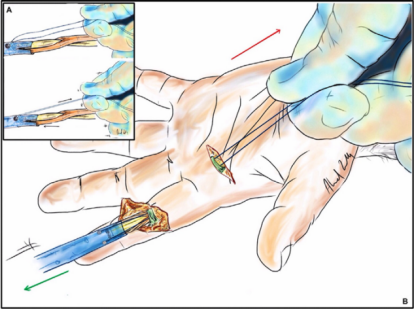 手部II区屈肌腱断裂回缩后难以取出，该如何处理？