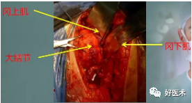 肱骨近端骨折：解剖、分型、治疗及内固定全面讲解！