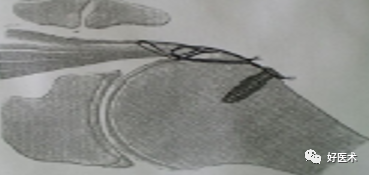 肱骨近端骨折：解剖、分型、治疗及内固定全面讲解！