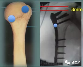 肱骨近端骨折：解剖、分型、治疗及内固定全面讲解！
