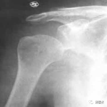 肱骨近端骨折：解剖、分型、治疗及内固定全面讲解！