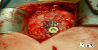 肱骨近端骨折：解剖、分型、治疗及内固定全面讲解！