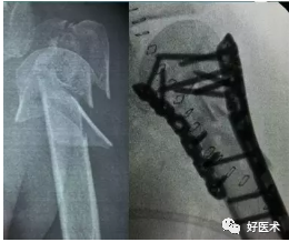 肱骨近端骨折：解剖、分型、治疗及内固定全面讲解！