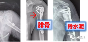 肱骨近端骨折：解剖、分型、治疗及内固定全面讲解！