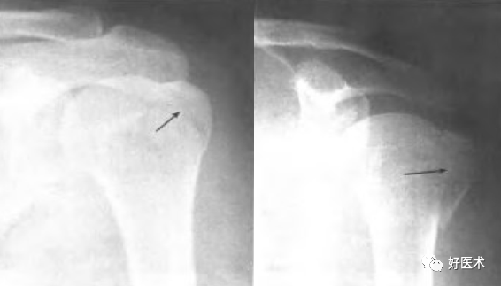 肱骨近端骨折：解剖、分型、治疗及内固定全面讲解！