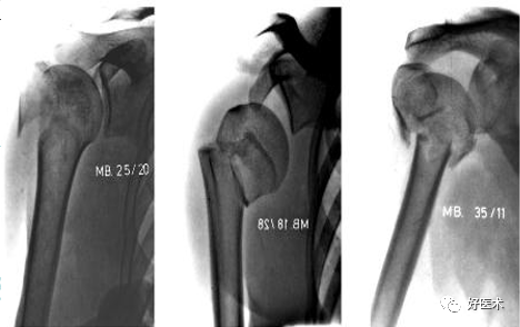肱骨近端骨折：解剖、分型、治疗及内固定全面讲解！