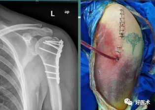 肱骨近端骨折：解剖、分型、治疗及内固定全面讲解！