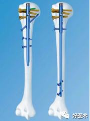 肱骨近端骨折：解剖、分型、治疗及内固定全面讲解！