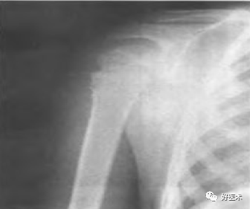 肱骨近端骨折：解剖、分型、治疗及内固定全面讲解！