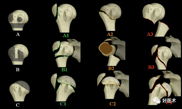 肱骨近端骨折：解剖、分型、治疗及内固定全面讲解！