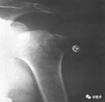 肱骨近端骨折：解剖、分型、治疗及内固定全面讲解！