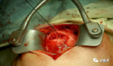 肱骨近端骨折：解剖、分型、治疗及内固定全面讲解！