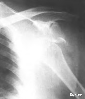 肱骨近端骨折：解剖、分型、治疗及内固定全面讲解！