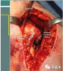 肱骨近端骨折：解剖、分型、治疗及内固定全面讲解！