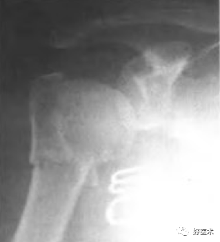 肱骨近端骨折：解剖、分型、治疗及内固定全面讲解！