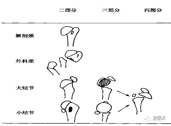 肱骨近端骨折：解剖、分型、治疗及内固定全面讲解！