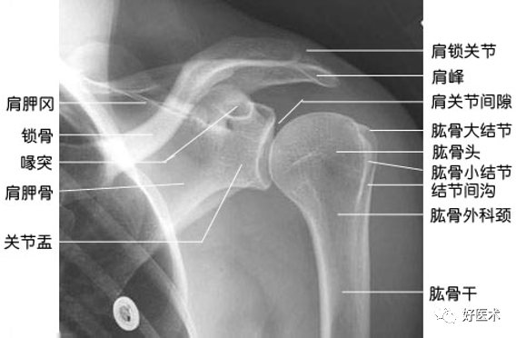 肱骨近端骨折：解剖、分型、治疗及内固定全面讲解！