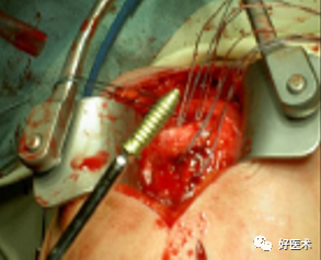 肱骨近端骨折：解剖、分型、治疗及内固定全面讲解！