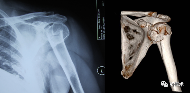 肱骨近端骨折：解剖、分型、治疗及内固定全面讲解！