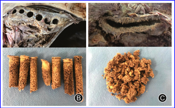骨科基本技术：成人髂前棘骨移植物获取方法总结