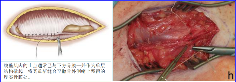 骨科基本技术：成人髂前棘骨移植物获取方法总结