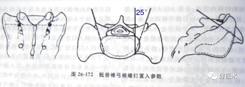 颈、胸、腰椎椎弓根钉置钉技巧，必备高清图解（全）！