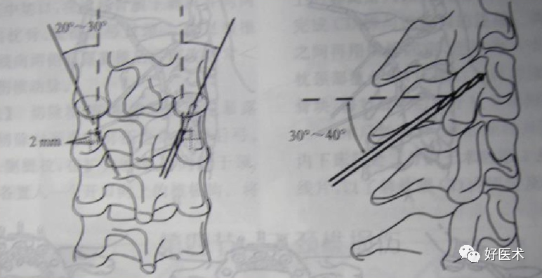 颈、胸、腰椎椎弓根钉置钉技巧，必备高清图解（全）！