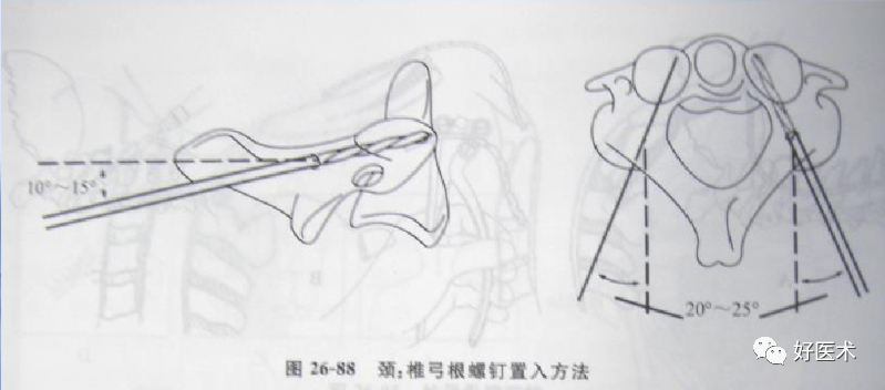 颈、胸、腰椎椎弓根钉置钉技巧，必备高清图解（全）！