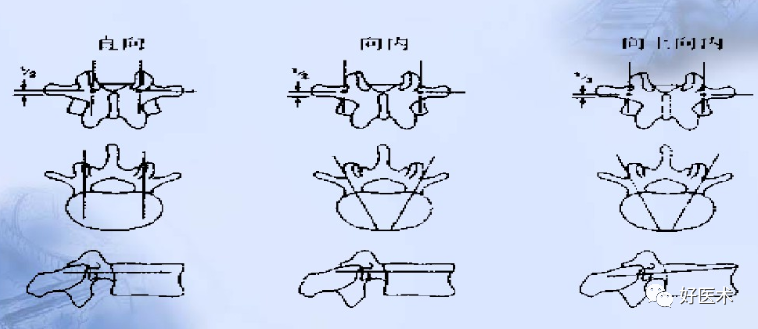 颈、胸、腰椎椎弓根钉置钉技巧，必备高清图解（全）！