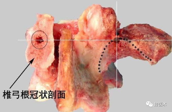 颈、胸、腰椎椎弓根钉置钉技巧，必备高清图解（全）！