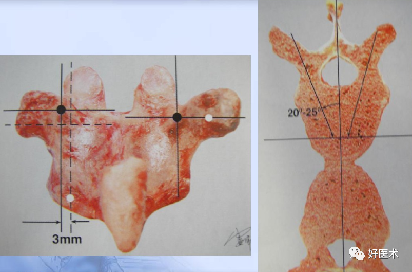 颈、胸、腰椎椎弓根钉置钉技巧，必备高清图解（全）！