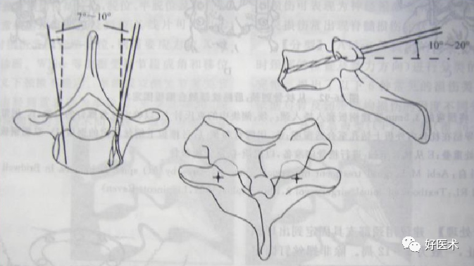 颈、胸、腰椎椎弓根钉置钉技巧，必备高清图解（全）！