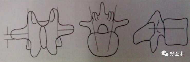 颈、胸、腰椎椎弓根钉置钉技巧，必备高清图解（全）！