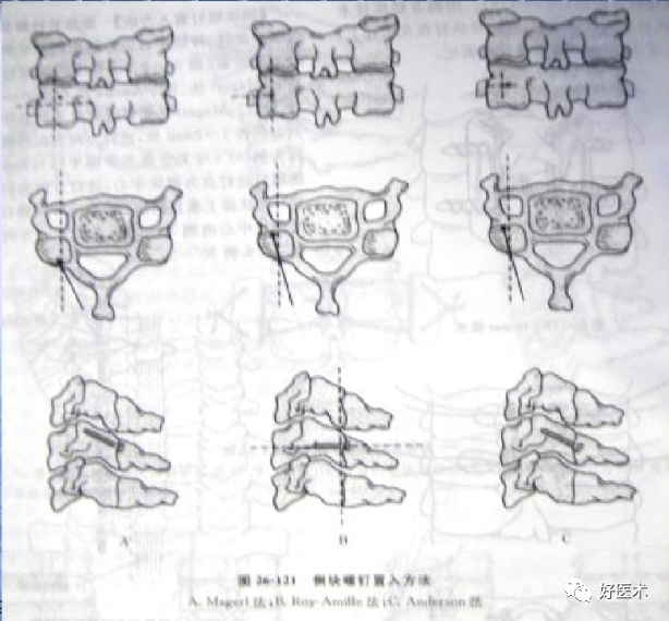 颈、胸、腰椎椎弓根钉置钉技巧，必备高清图解（全）！