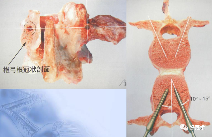 颈、胸、腰椎椎弓根钉置钉技巧，必备高清图解（全）！