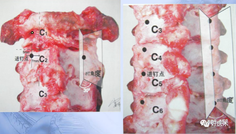 颈、胸、腰椎椎弓根钉置钉技巧，必备高清图解（全）！
