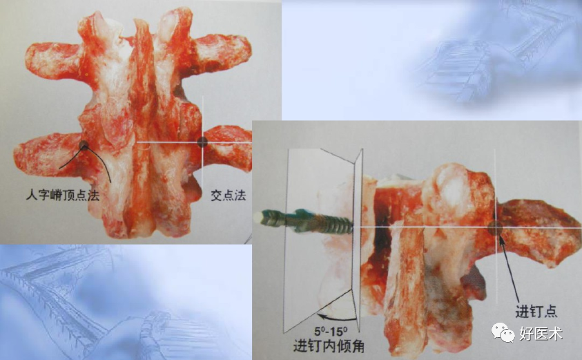 颈、胸、腰椎椎弓根钉置钉技巧，必备高清图解（全）！