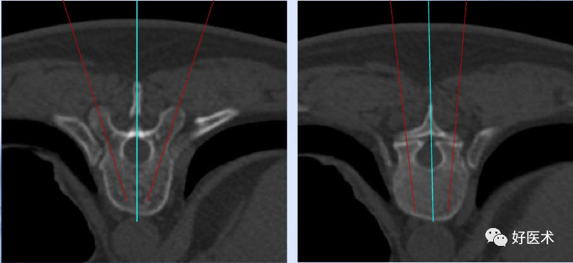 颈、胸、腰椎椎弓根钉置钉技巧，必备高清图解（全）！