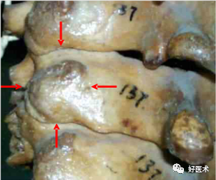 颈、胸、腰椎椎弓根钉置钉技巧，必备高清图解（全）！