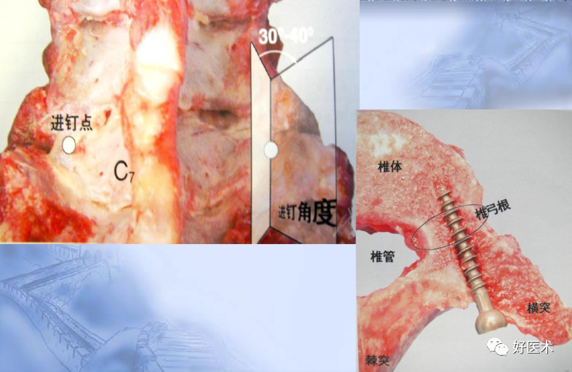 颈、胸、腰椎椎弓根钉置钉技巧，必备高清图解（全）！
