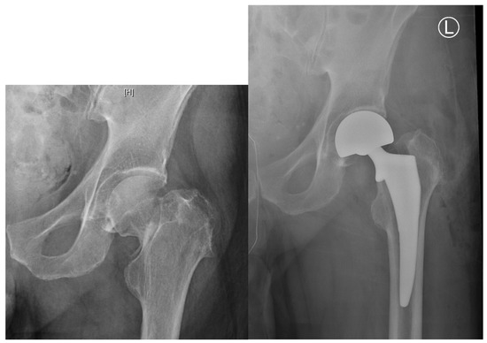 髋部骨折：相关解剖学、分型、治疗、骨折的生物力学，一文讲清！