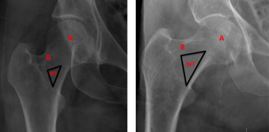 髋部骨折：相关解剖学、分型、治疗、骨折的生物力学，一文讲清！