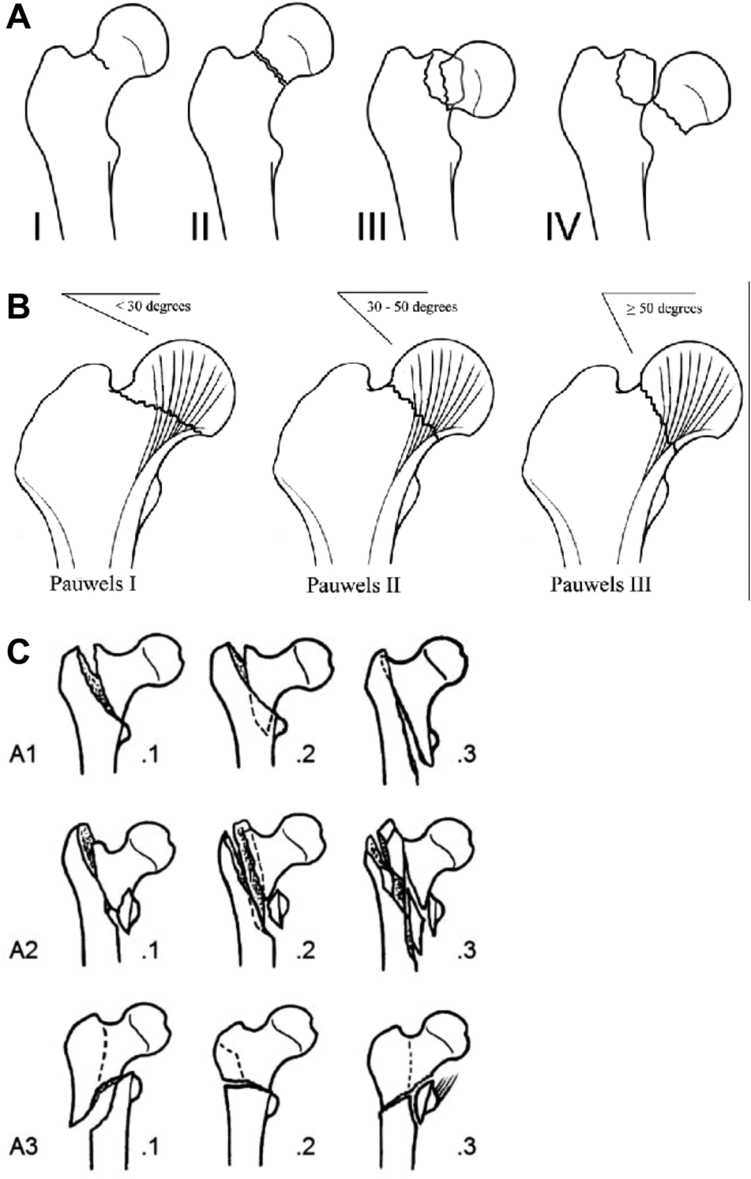 髋部骨折：相关解剖学、分型、治疗、骨折的生物力学，一文讲清！