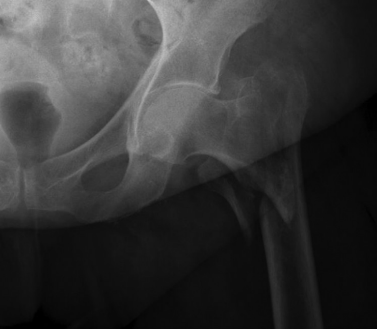 髋部骨折：相关解剖学、分型、治疗、骨折的生物力学，一文讲清！