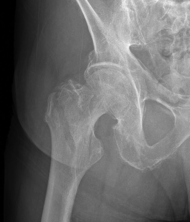 髋部骨折：相关解剖学、分型、治疗、骨折的生物力学，一文讲清！