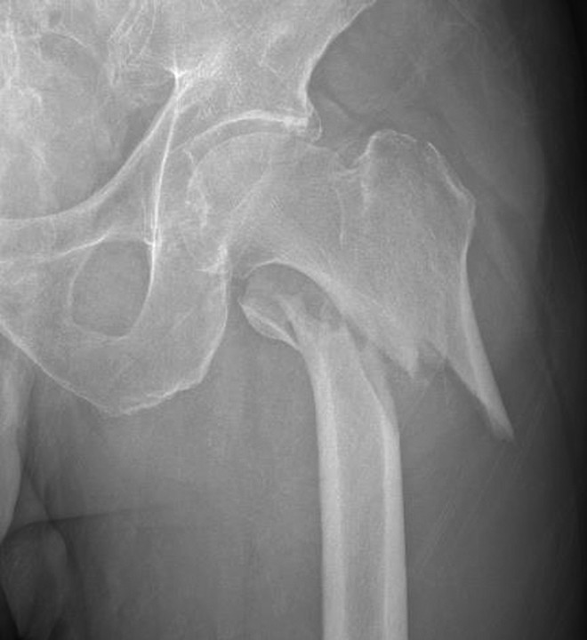 髋部骨折：相关解剖学、分型、治疗、骨折的生物力学，一文讲清！