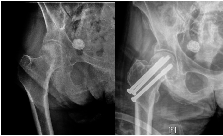 髋部骨折：相关解剖学、分型、治疗、骨折的生物力学，一文讲清！