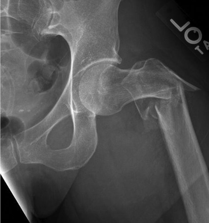 髋部骨折：相关解剖学、分型、治疗、骨折的生物力学，一文讲清！