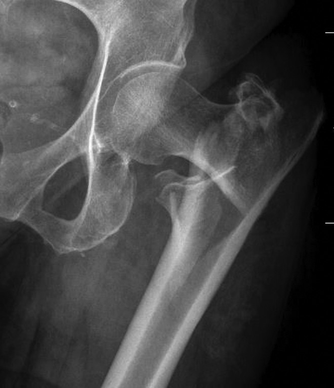 髋部骨折：相关解剖学、分型、治疗、骨折的生物力学，一文讲清！